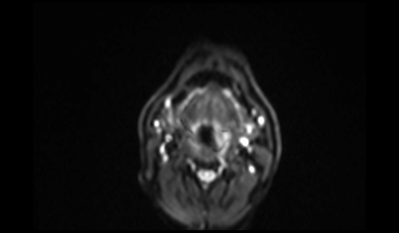 RESOLVE DWI Axial b50 Image of Neck
