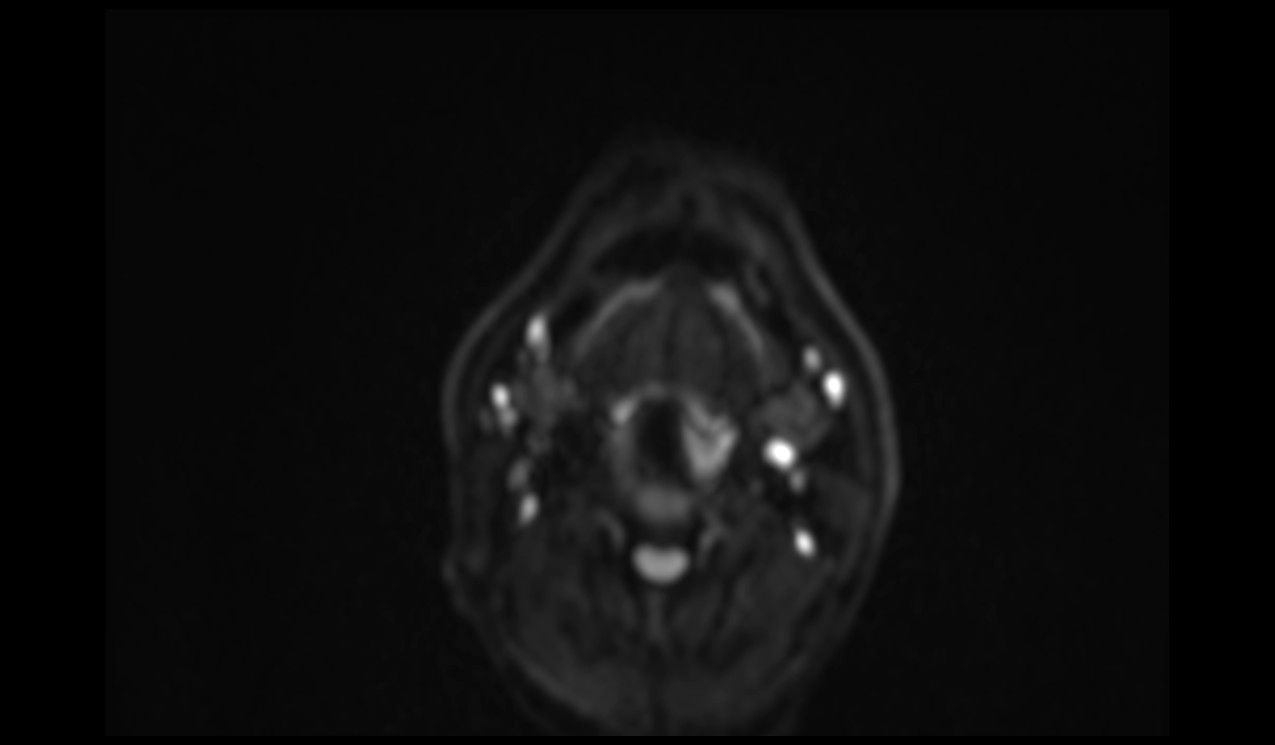RESOLVE DWI Axial b800 Image of Neck
