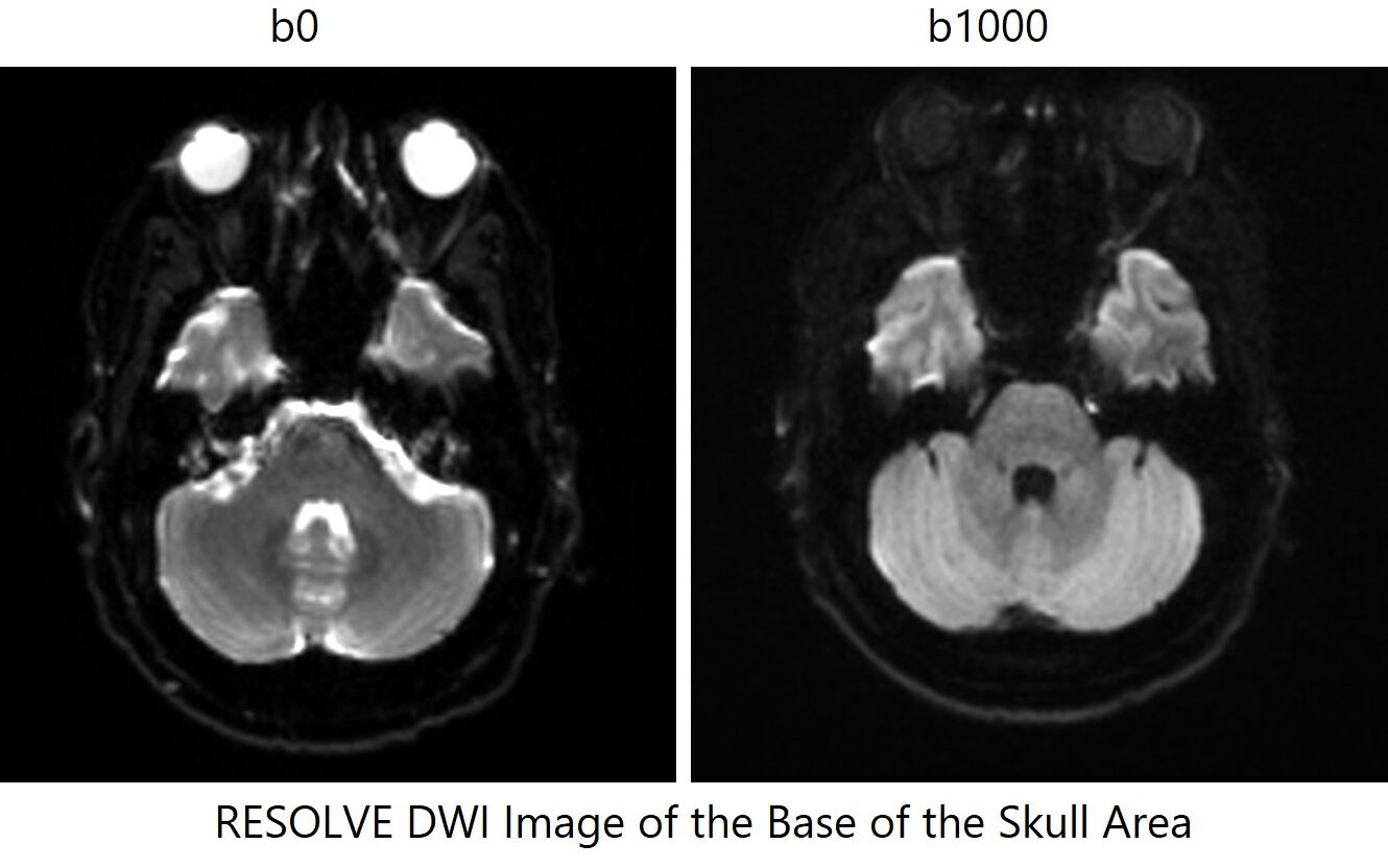 RESOLVE DWI image of the base of the skull area