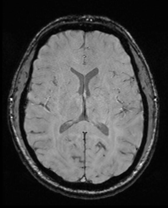 SWI MRI magnitude image