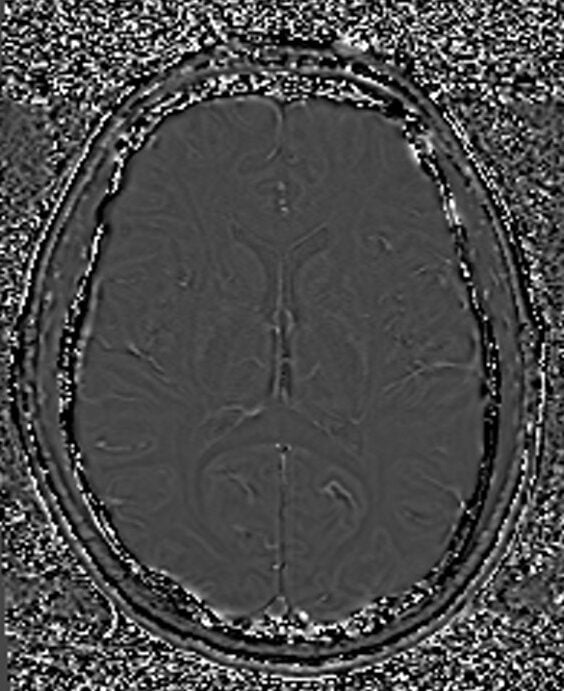 SWI MRI phase image