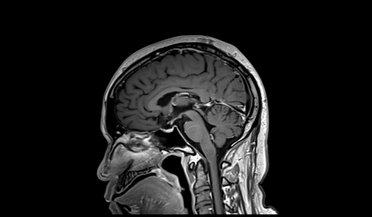 T1 SPACE 3D sequence ised in brain imaging
