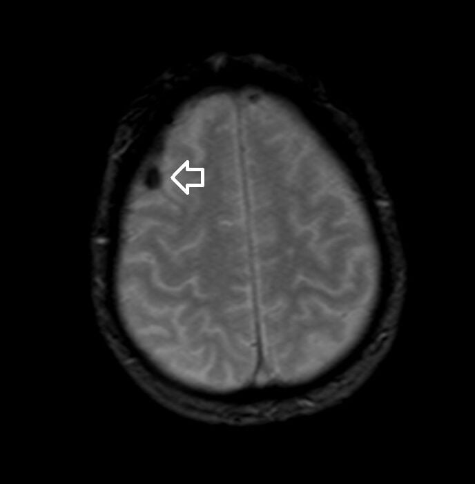 T2 star Image of the Brain Hemorrhage