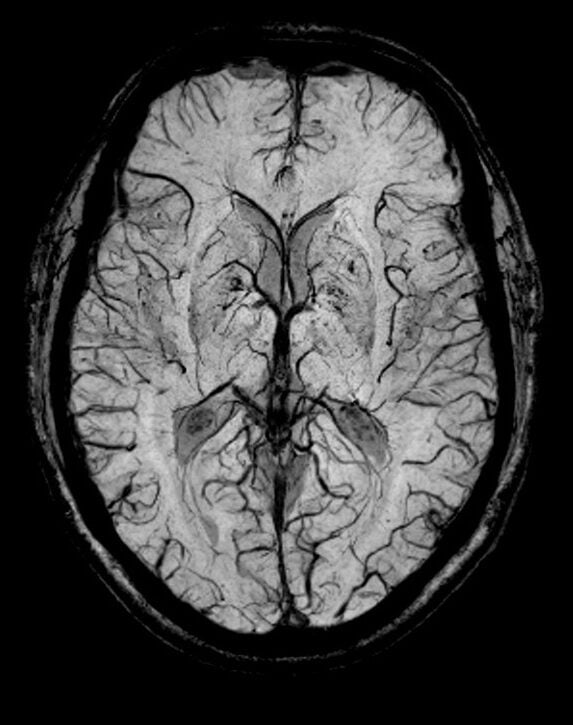 T2 star SWI image of brain