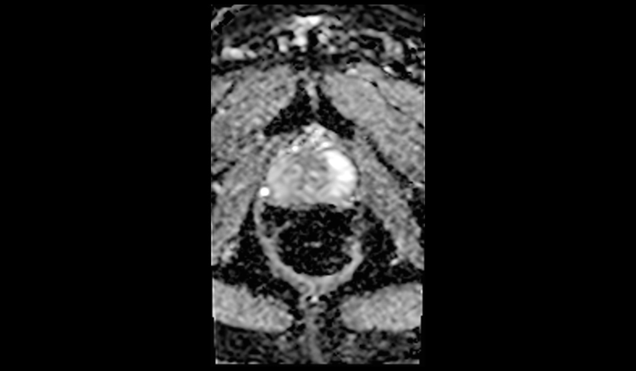 ZOOMit-DWI ADC image of prostate