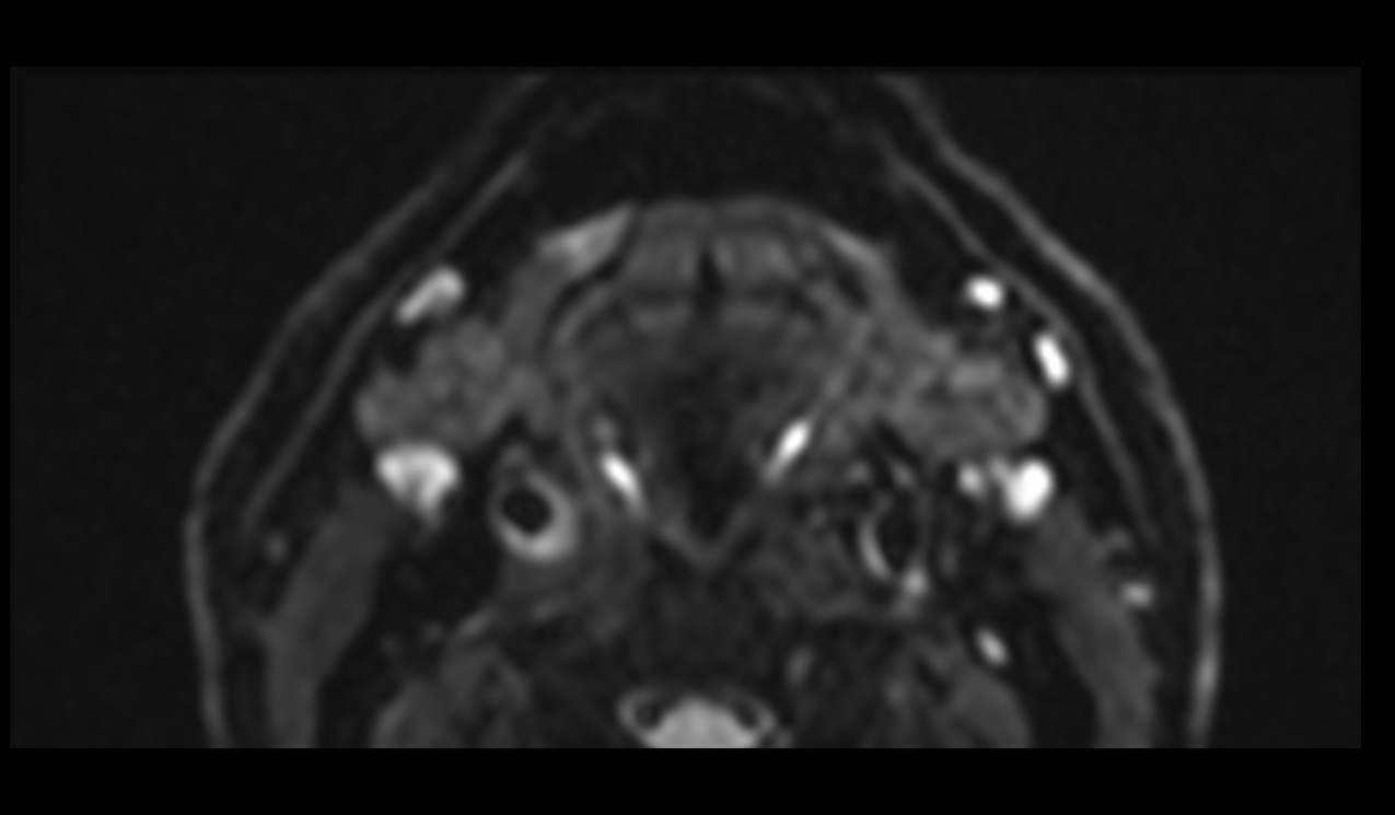 ZOOMit-DWI b0 image of neck