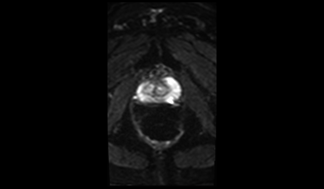 ZOOMit-DWI b0 image of prostate