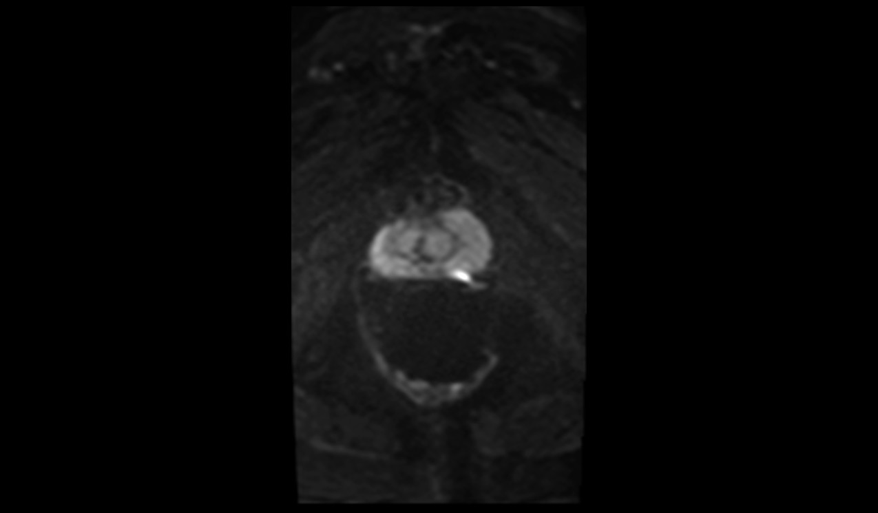 ZOOMit-DWI b800 image of prostate