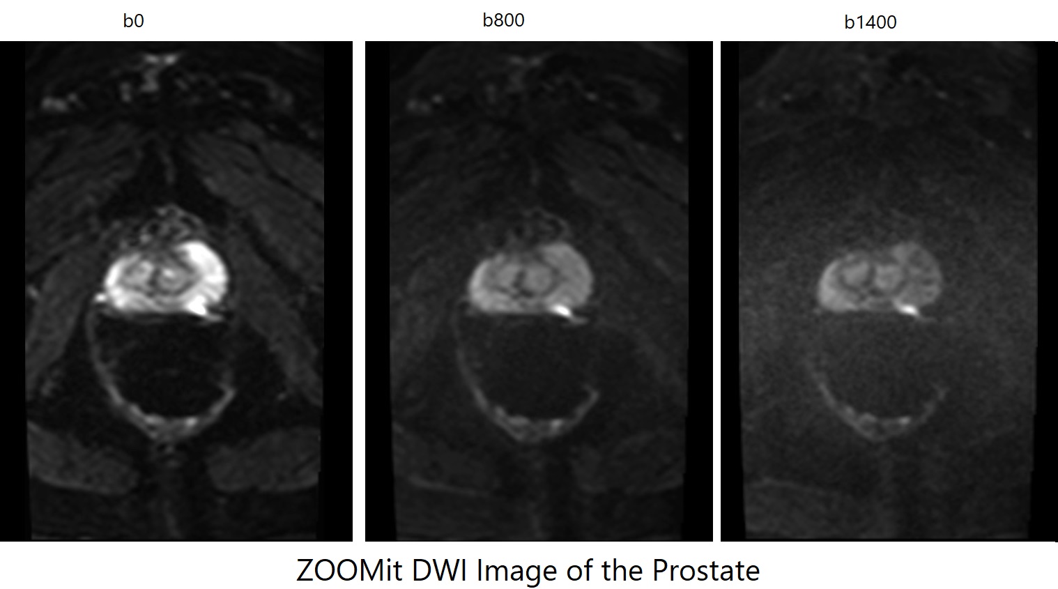 ZOOMit DWI image of the prostate