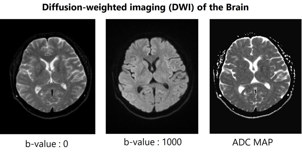Image of Diffusion-weighted imaging (DWI) of the brain