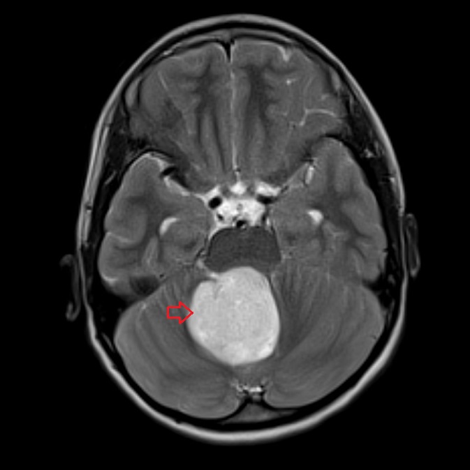 MRI image of Medulloblastoma