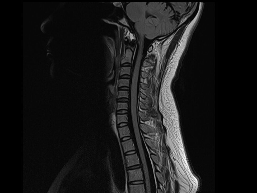 T2 FLAIR sagittal sequence used in 3T cervical spine imaging