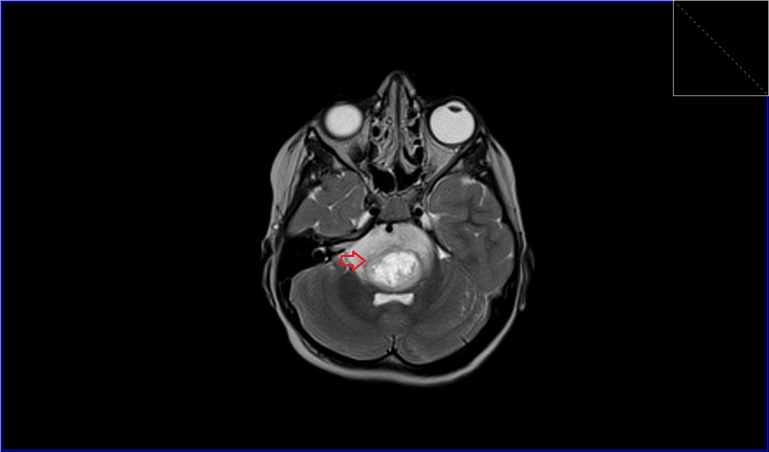 T2 axial image shows Pontine Glioma