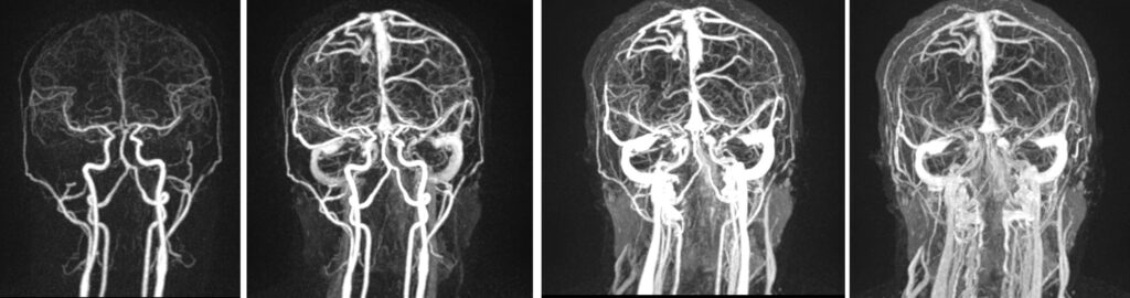 TWIS MRA Brian and neck image for cavernous sinus