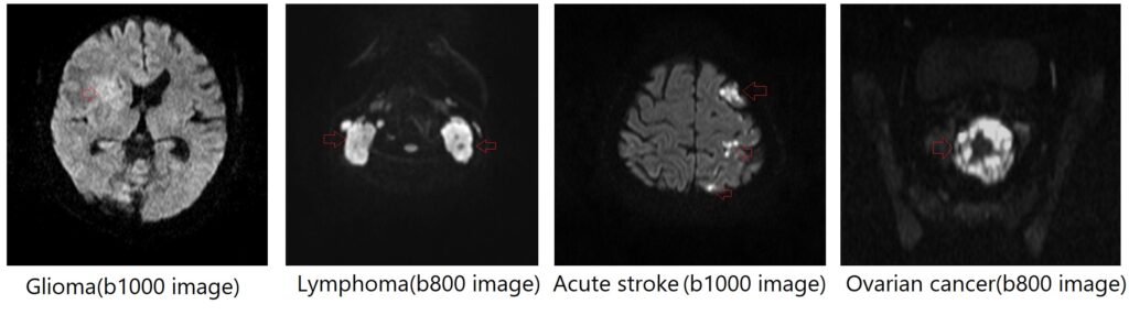 Various pathological appearances in Diffusion-weighted imaging (DWI)