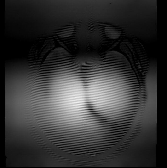Zebra Artifact or Zebra Stripes artifact MRI