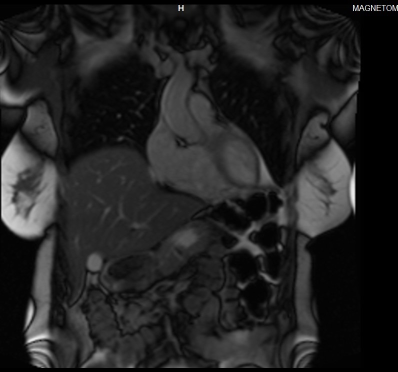 Cardiac MRI T2 localiser image 1
