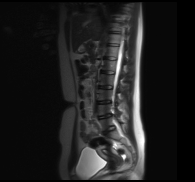 L spine t2 localiser image 1