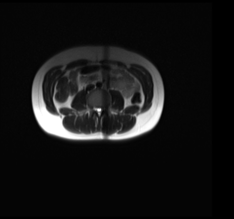 L spine t2 localiser image 3