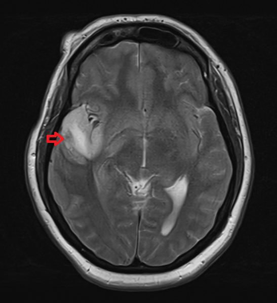 MRI T2 TSE axial image of herpes simplex encephalitis