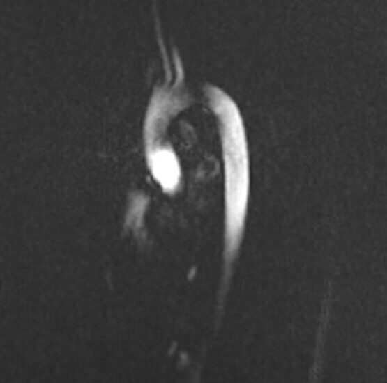 Magnitude Image of Phase-contrast (PC) sequence used in cardiac flow imaging
