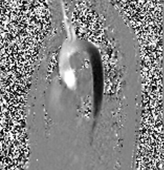 Phase Image of Phase-contrast (PC) sequence used in cardiac flow imaging