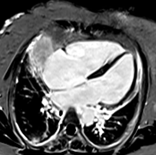 Phase-contrast (PC) 2-Chambar sequence with TI 245 used in Delayed post-contrast imaging (Phase image)