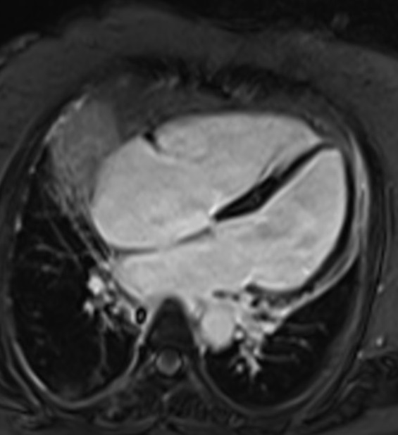 Phase-contrast (PC) 2-Chambar sequence with TI 245 used in Delayed post-contrast imaging (magnitude image)