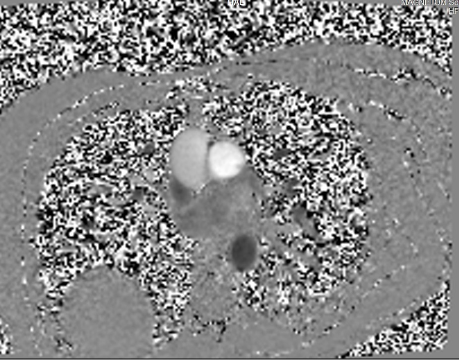 Phase-contrast (PC) sequence used in through-plane pulmonary artery (Phase Image)