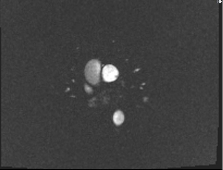 Phase-contrast (PC) sequence used in through-plane pulmonary artery imaging (phase image)