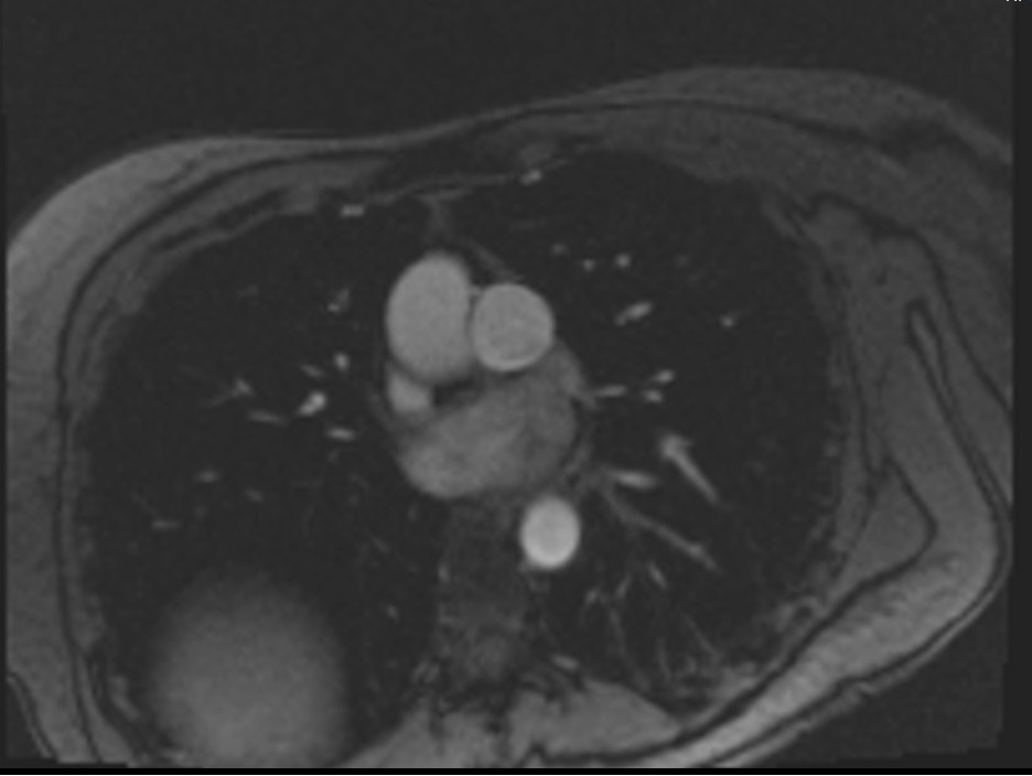 Phase-contrast (PC) sequence used in through-plane pulmonary artery imaging (re-phased image)