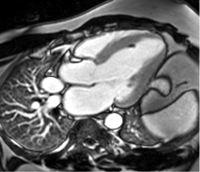 Phase-contrast (PC) sequence with TI 450 used in Immediate Post-Contrast (magnitude image )
