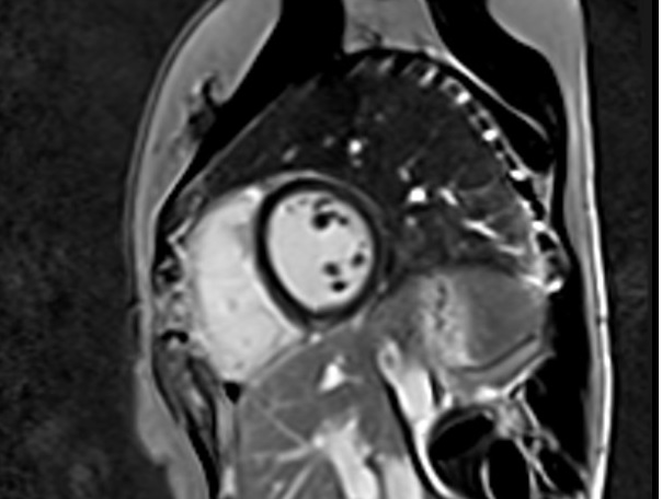 Phase-contrast (PC) short axis sequence with TI 245 used in Delayed post-contrast imaging (Phase image)