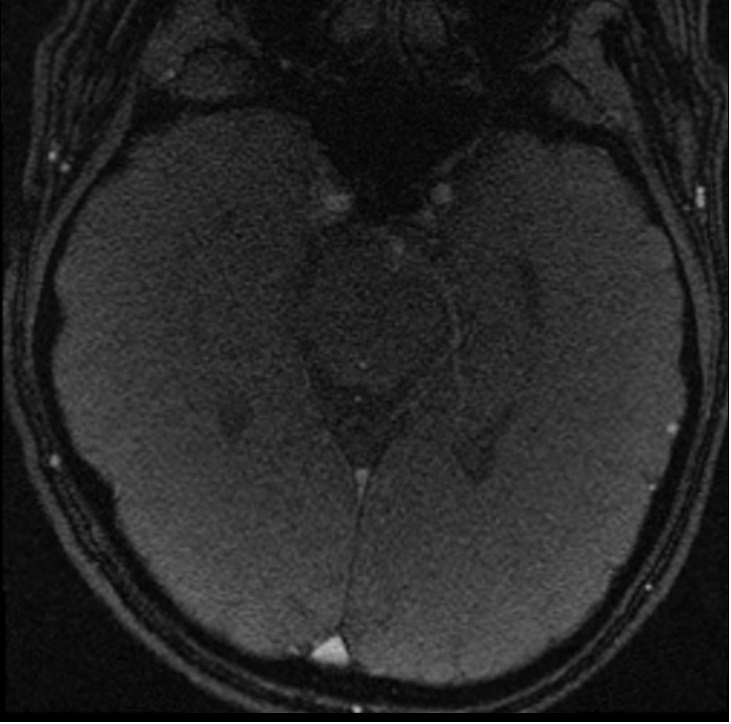 Re-phased Image of Phase-contrast (PC) sequence used in CSF flow imaging