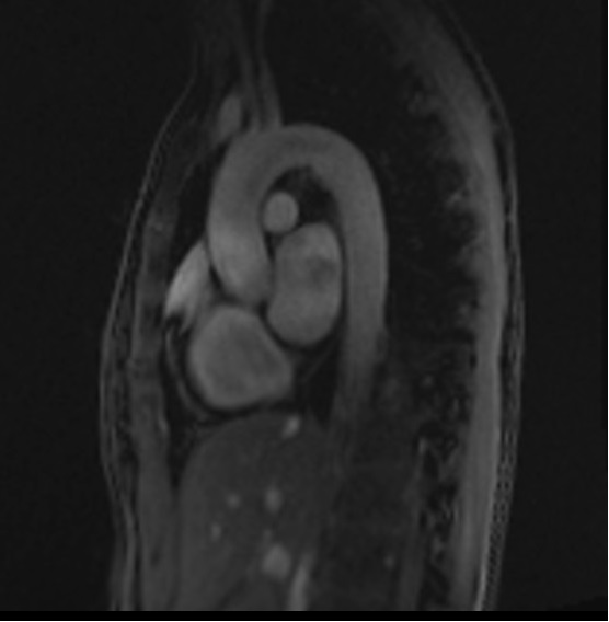 Re-phased Image of Phase-contrast (PC) sequence used in cardiac flow imaging