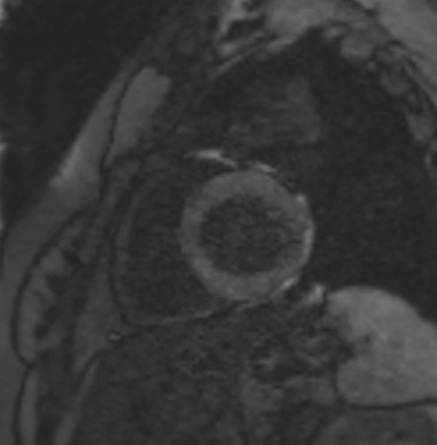 TI scout (look-locker) MRI with TI 110