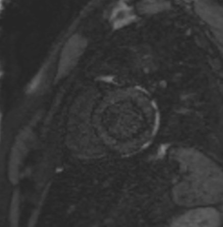 TI scout (look-locker) MRI with TI 150