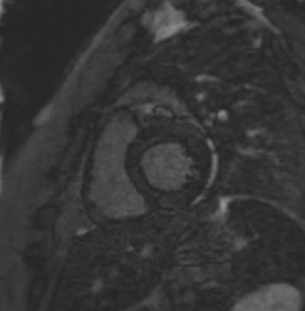 TI scout (look-locker) MRI with TI 200