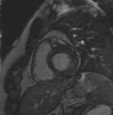 TI scout (look-locker) MRI with TI 280