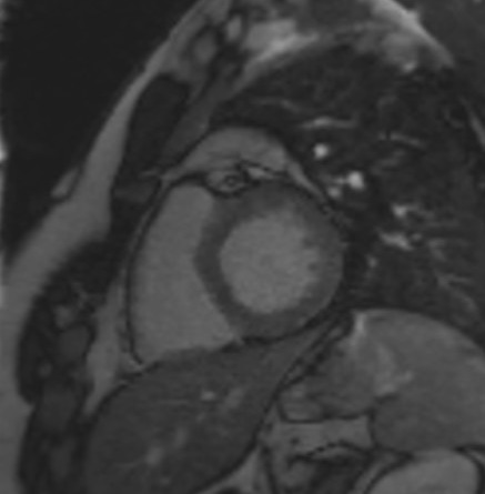 TI scout (look-locker) MRI with TI 350