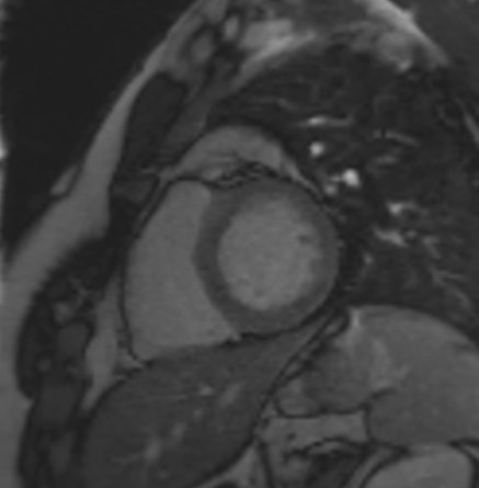 TI scout (look-locker) MRI with TI 400