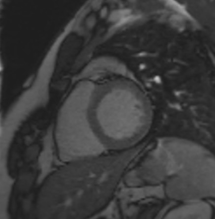 TI scout (look-locker) MRI with TI 450
