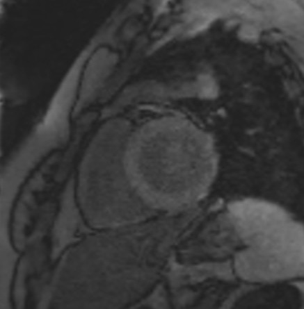 TI scout (look-locker) MRI with TI 90