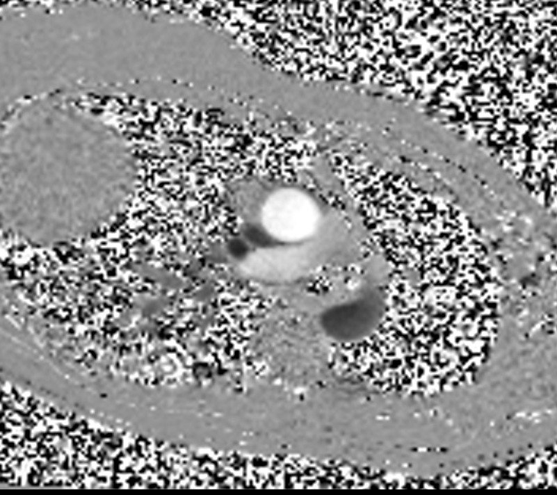 through plane aortic flow mri magnitude image