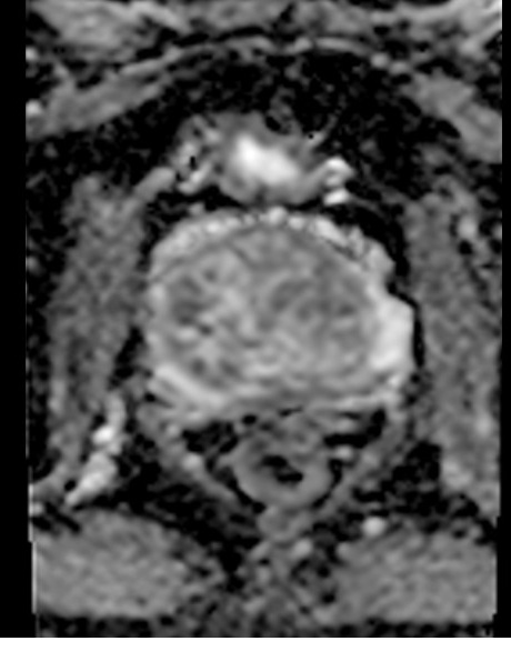 ADC MAP of prostate MRI