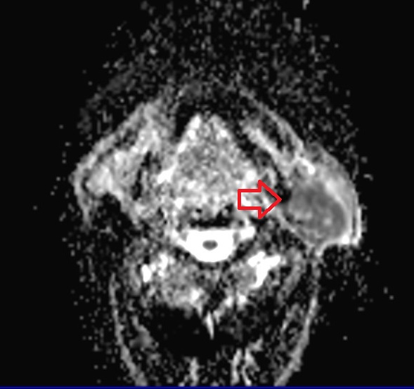 ADC axial image shows Warthin's tumor