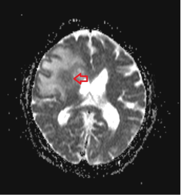 ADC axial image shows brain glioma