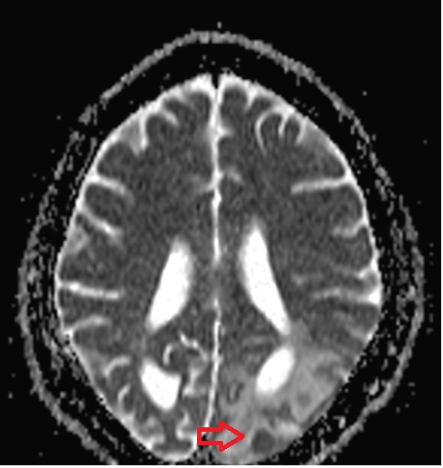 ADC axial image shows brain tb