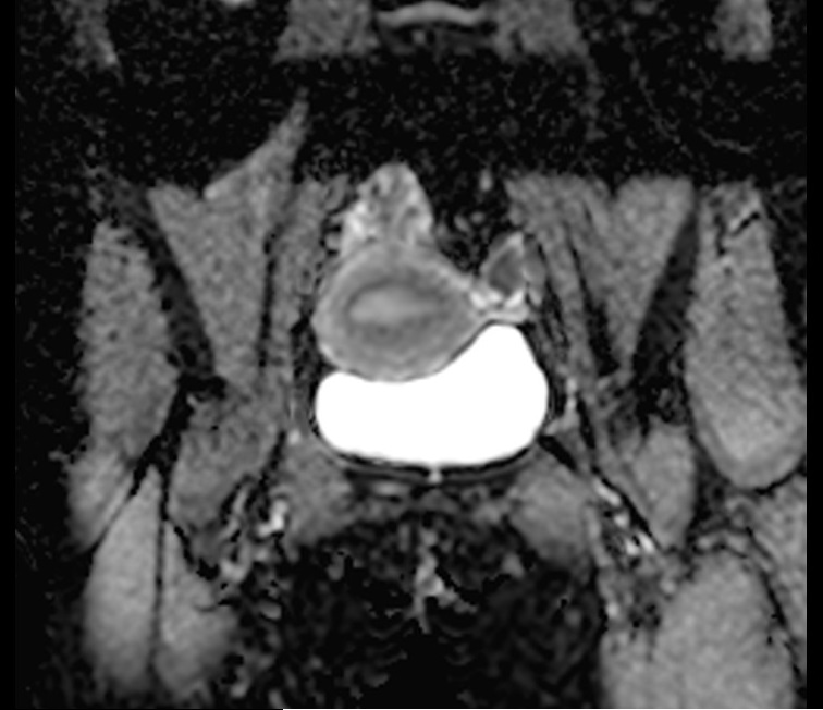 ADC map endometrium DWI