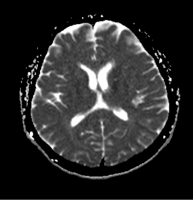 ADC map of brain mri